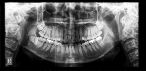 Dental Radiographs by dentist in Denver and Lone Tree CO