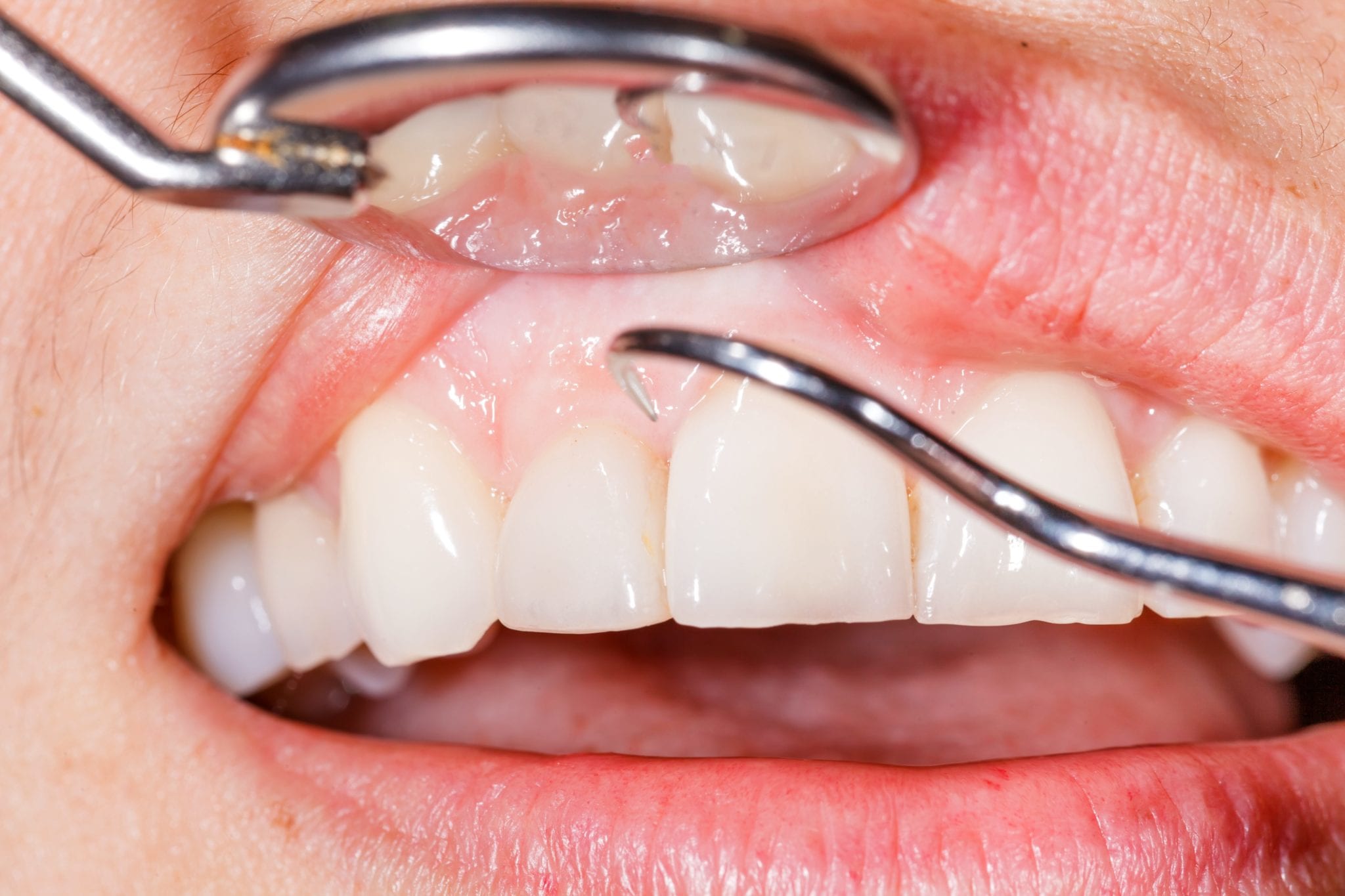 Denver and Lone Tree dentist describes Dental Exams and Dentistry