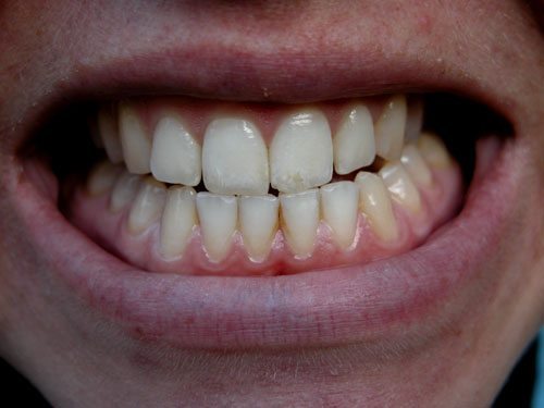 Teeth Grinding Bruxism Treatment by dentist in Denver and Lone Tree