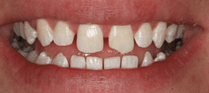 Veneers Before1