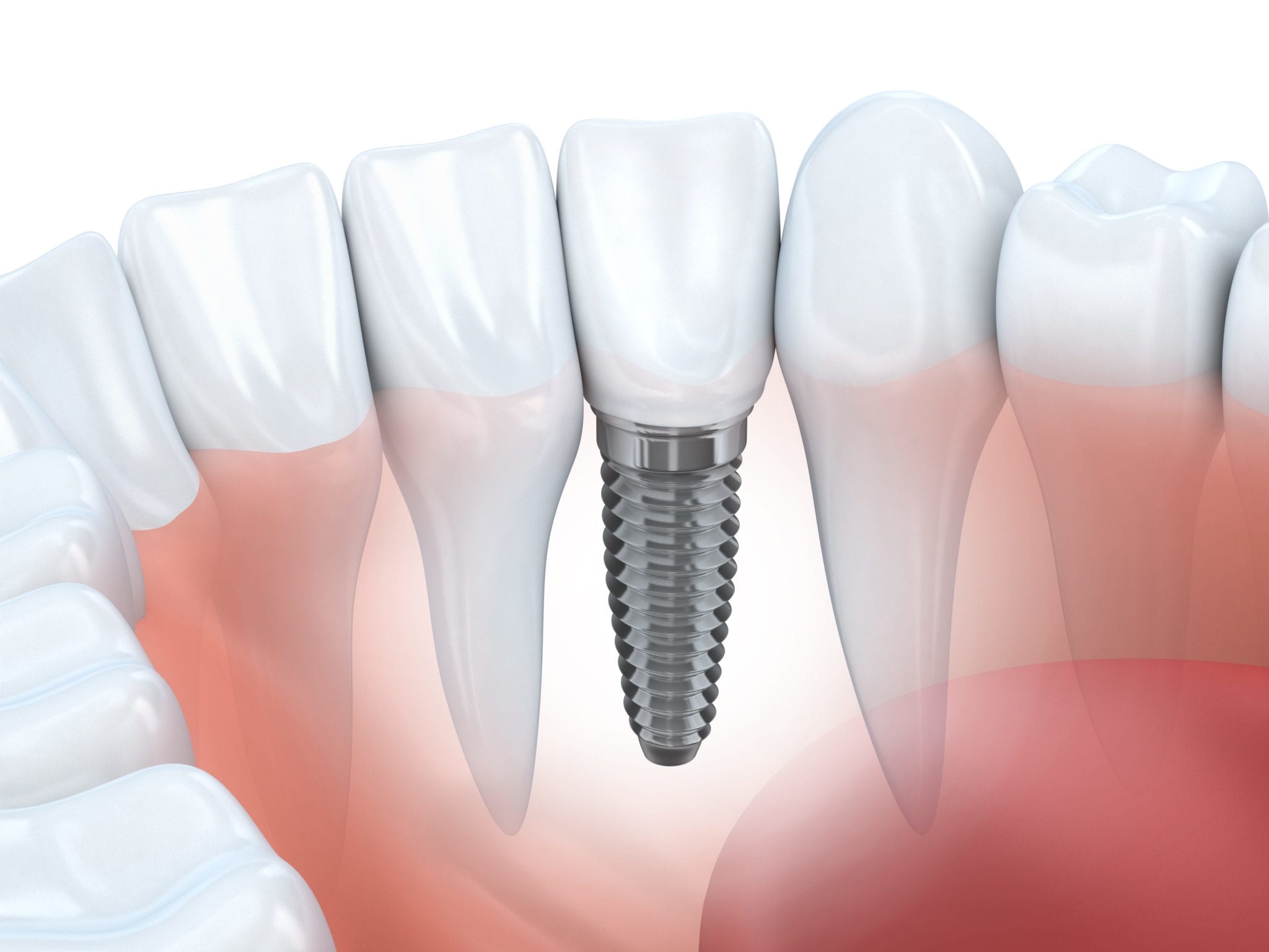 dental implants denver CO dentist
