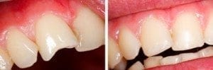 Composite Filling Denver Dentist Before and After