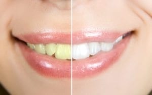 Cosmetic Dentist Denver CO Before and After