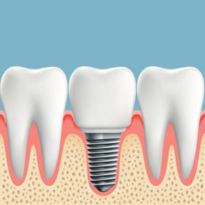 digital illustration of dental implant placed between two molars