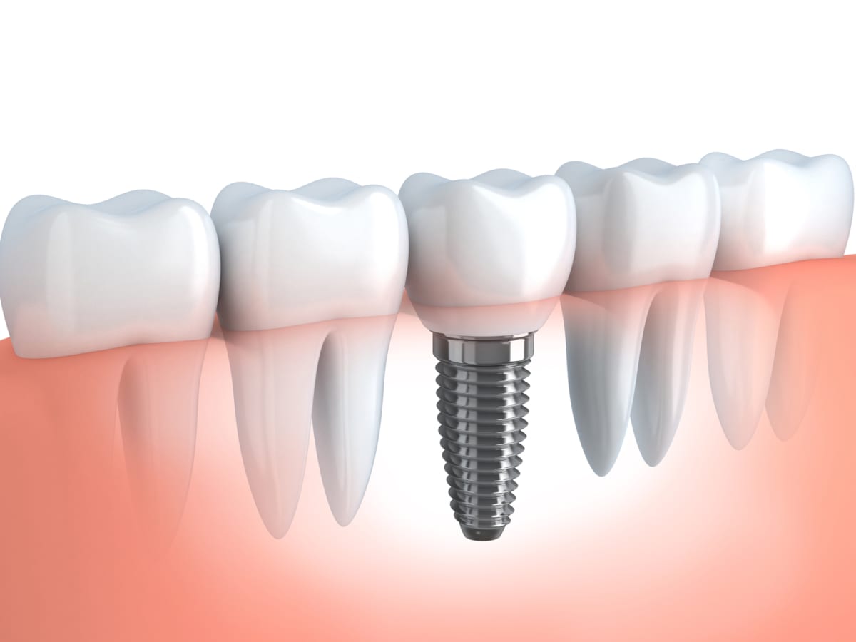 When it comes to Denver tooth replacement options, we choose dental implants!