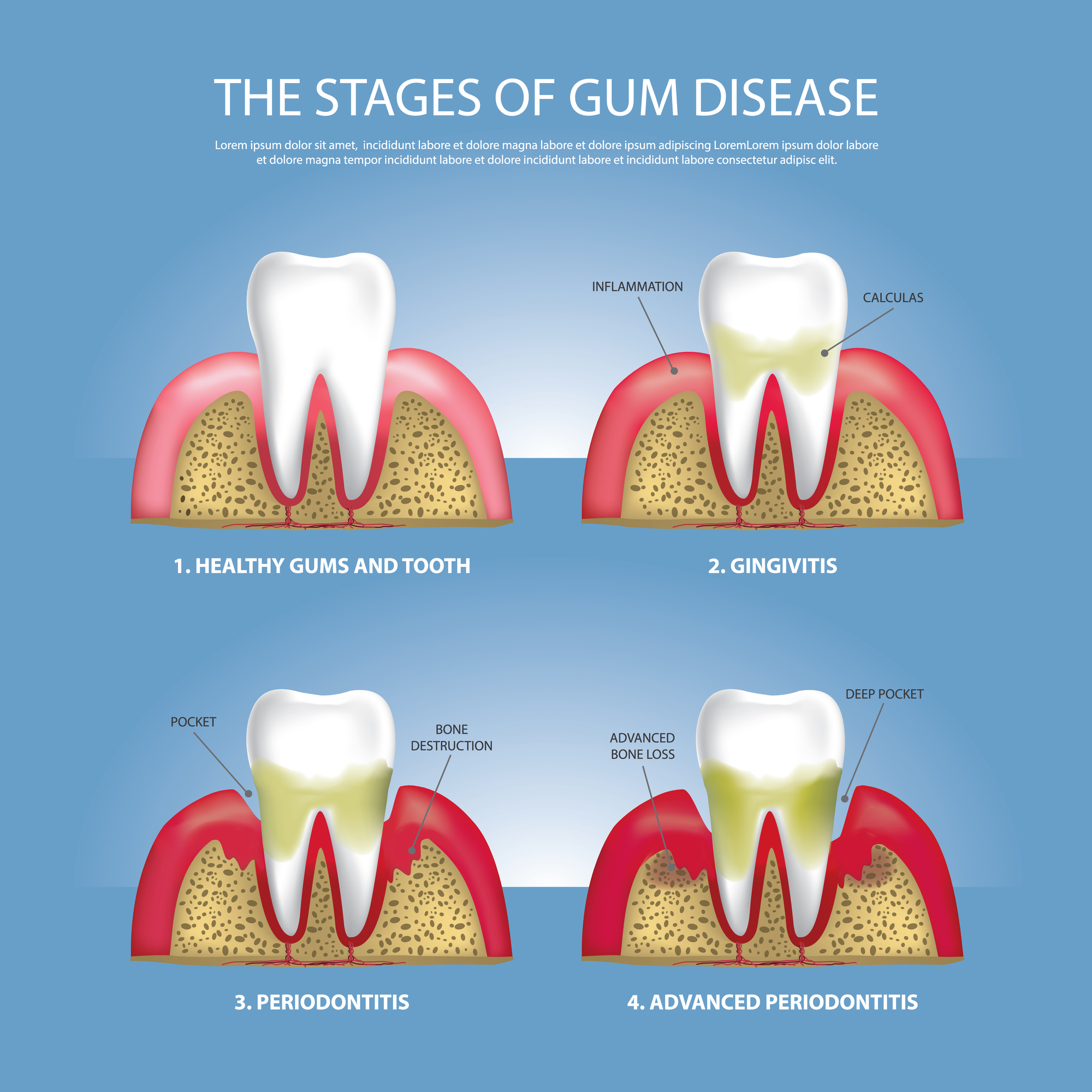 How To Stop The Progression Of Gum Disease Metro Dental Care 7923