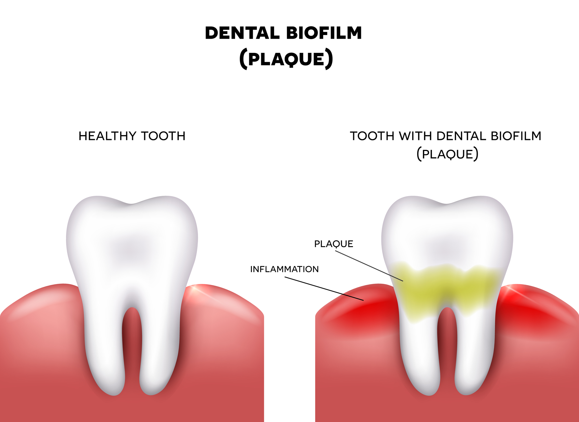 the-difference-between-healthy-unhealthy-dental-plaque-tc-dental-group