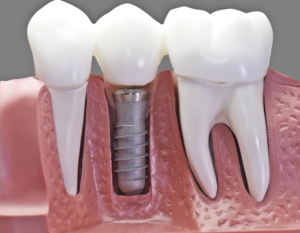 The Pros and Cons of a Dental Implant