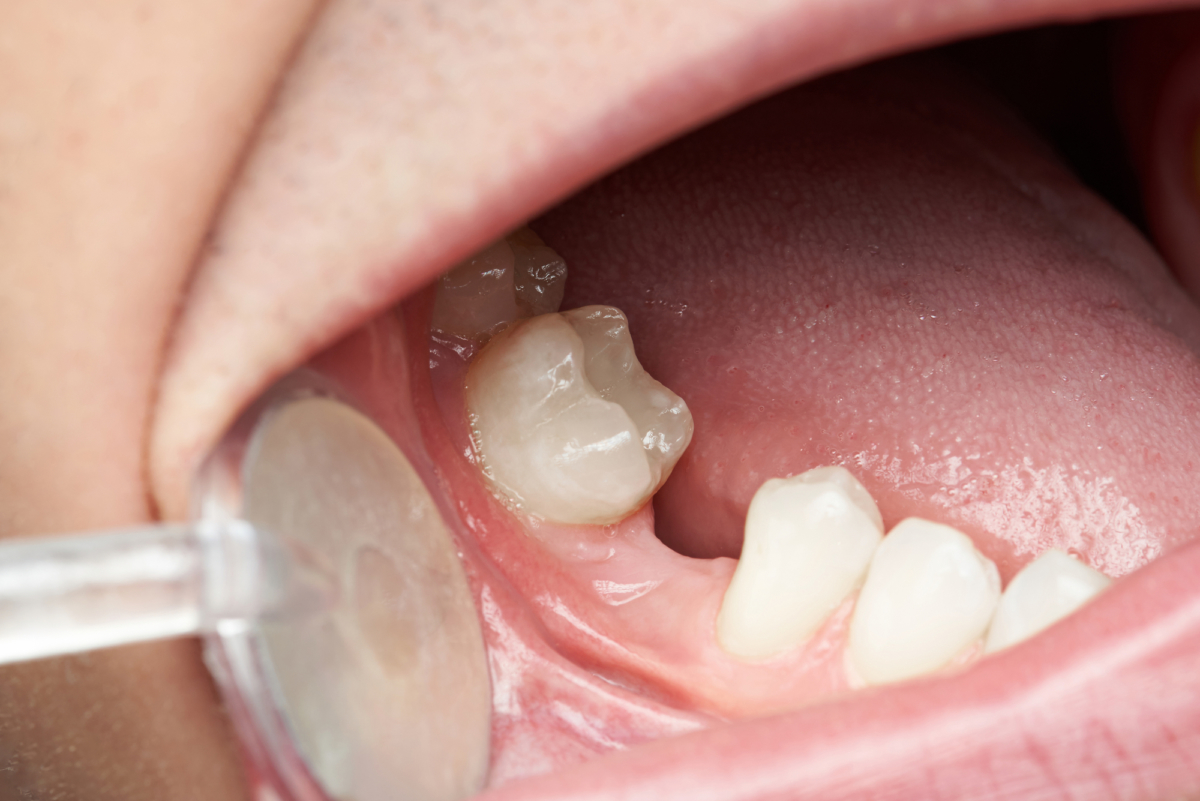 Tooth Replacement Options Dental Implants, Bridges, and Dentures