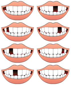 series of smiles with missing teeth