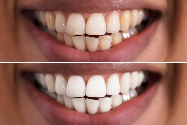 woman with teeth cleaning before and after photos