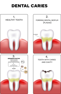 how cavities form diagram