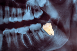 Dental panoramic x-ray. Medical concept. Dental treatment. Extraction of a wisdom tooth