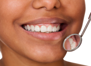 close up of black woman's teeth and gums before gum graft healing process