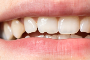 close up of woman's chipped from tooth