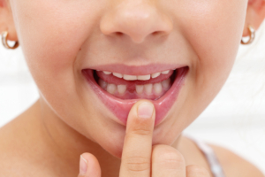 close up of little girl pointing to spot where baby tooth fell out