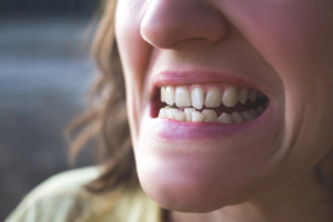 close up of woman's crooked teeth