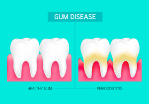 Periodontitis and inflammation of the gums. Healthy gum and periodontitis comparison. Dental care concept. Illustration on green background.