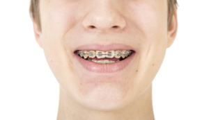 close up, cropped image of young man with orthodontics