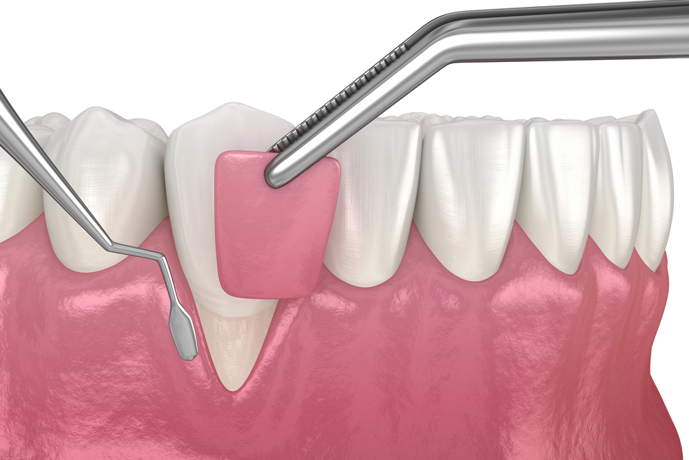 Gum Recession: Soft tissue graft surgery. 3D illustration of Dental treatment