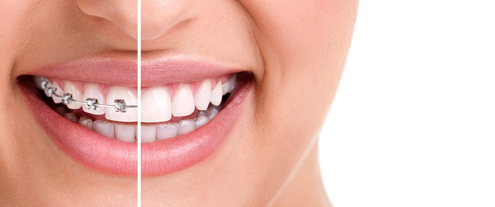 healthy smile with and without braces